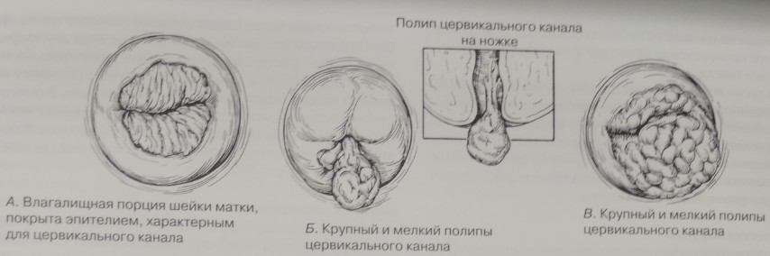  Заболевания шейки матки, при которых возможны кровяные выделения из половых путей во время беременности