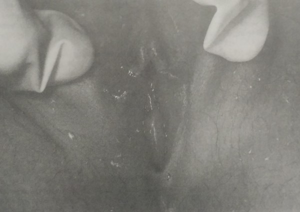 Склероатрофический лишай в области половых губ у 8-летней девочки