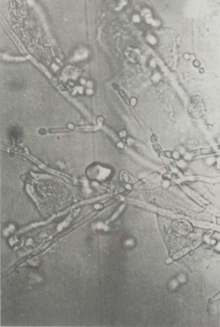 Микроскопия в физиологическом растворе при большом увеличении: определяются гифы С. albicans.