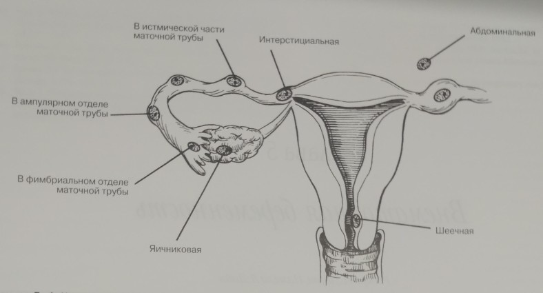 Частота встречаемости различных локализаций внематочной беременности.