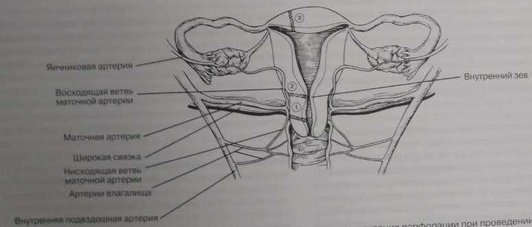  Анатомические особенности перфорации матки