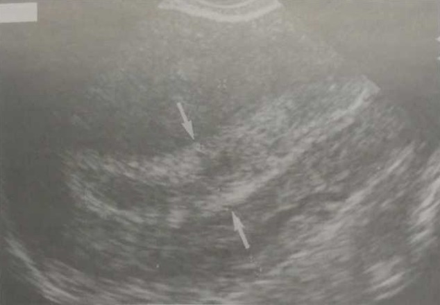 Трансвагинапьное УЗИ матки через несколько дней после артифициального аборта