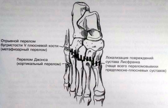  Переломы костей стопы