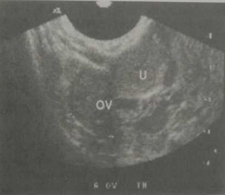 Ультразвуковая картина объемного образования правого придатка; срок беременности 8 недель.