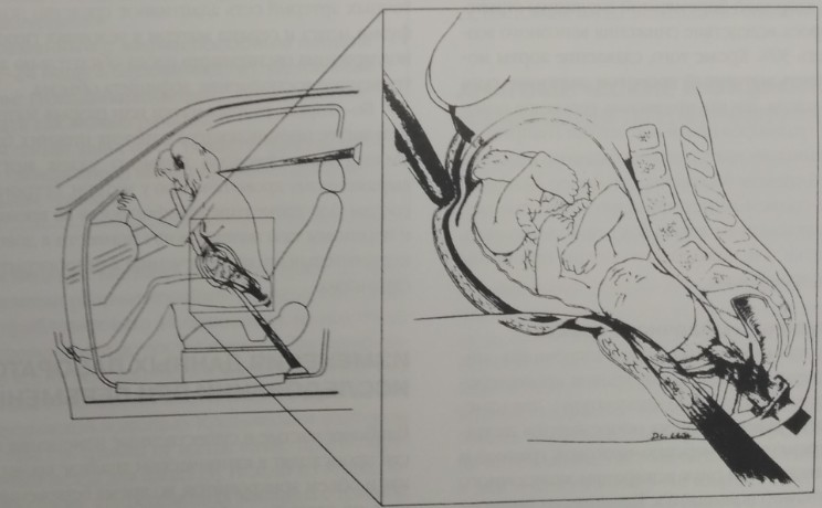 Иллюстрация преждевременной отслойки нормально расположенной плаценты в результате удара о рулевое колесо.