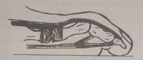 Деформация пальца типа «молоток»